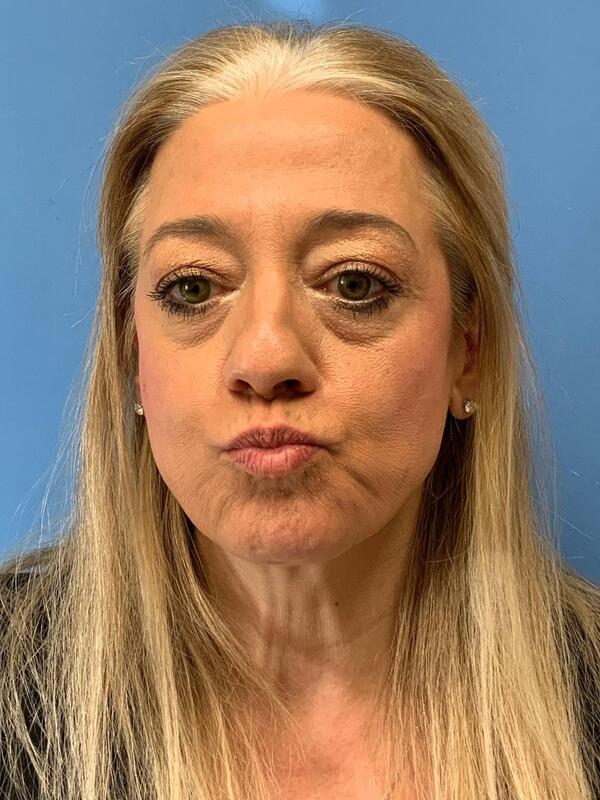 Gallery Before & After Image