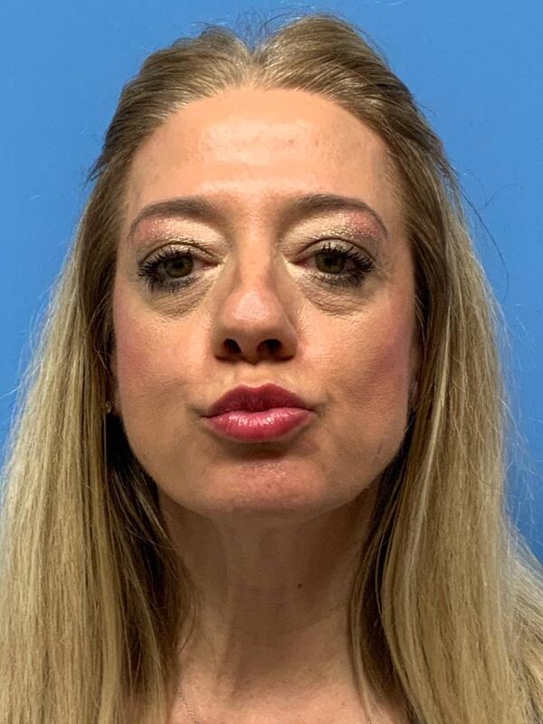 Gallery Before & After Image