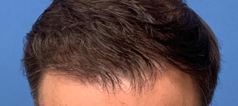 Gallery Before & After Image