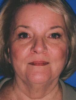 Gallery Before & After Image