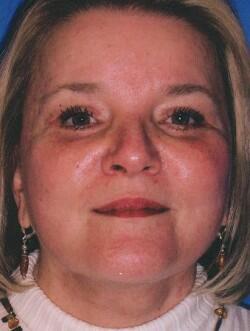 Gallery Before & After Image