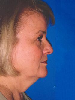 Gallery Before & After Image