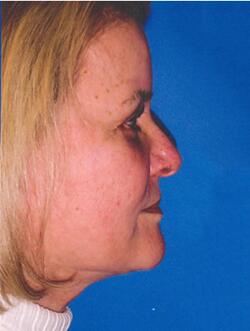 Gallery Before & After Image