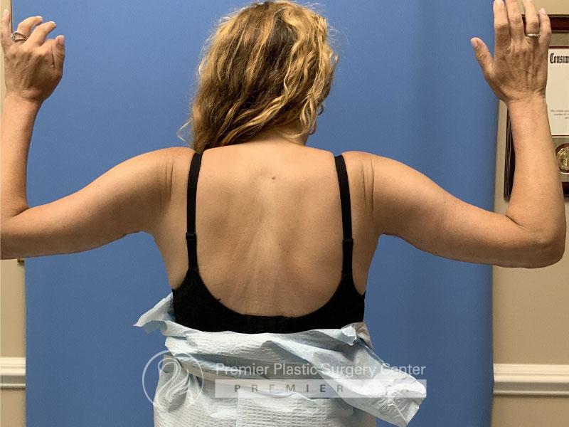 Brachioplasty Before & After Image