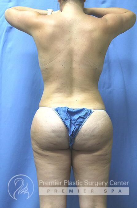 Brazillian Butt Lift Before & After Image