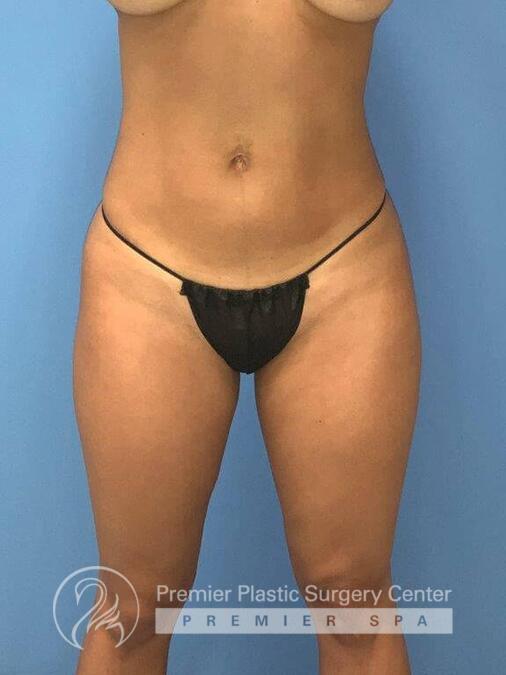 Brazillian Butt Lift Before & After Image