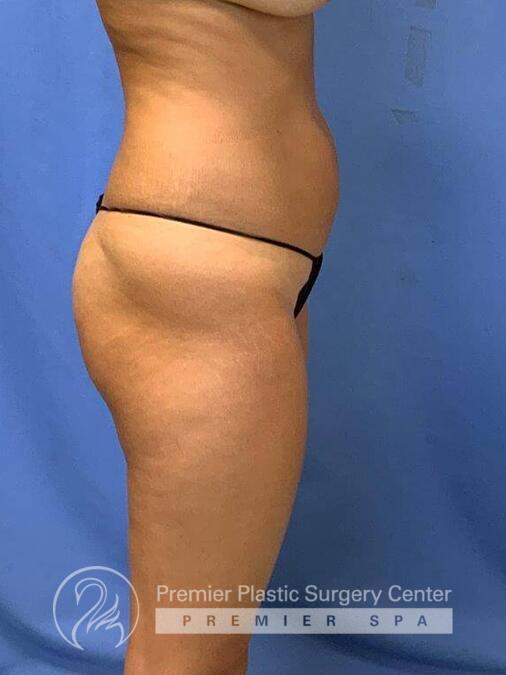 Brazillian Butt Lift Before & After Image