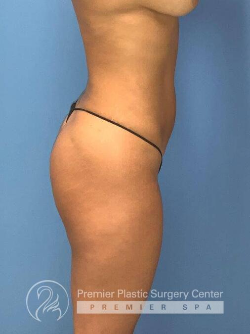 Brazillian Butt Lift Before & After Image