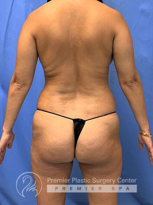 Brazillian Butt Lift Before & After Image
