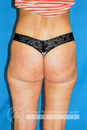 Brazillian Butt Lift Before & After Image
