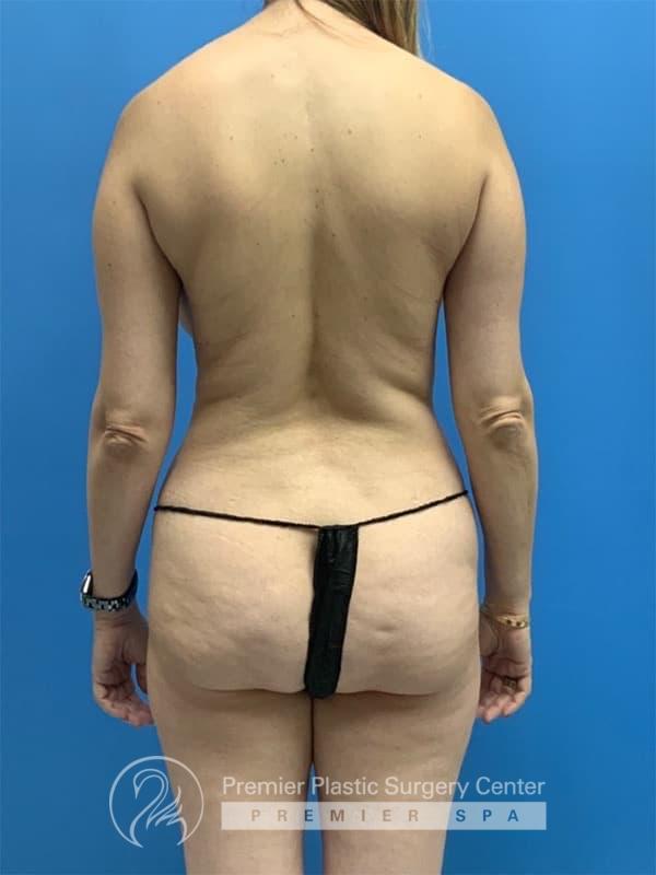 Liposuction Before & After Image