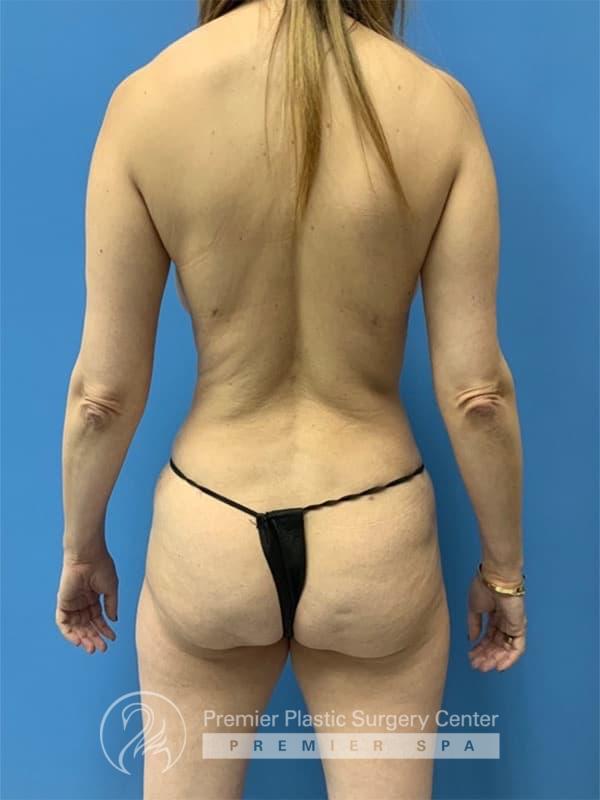 Liposuction Before & After Image