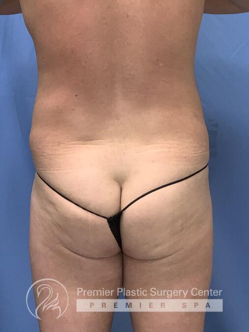 Liposuction Before & After Image