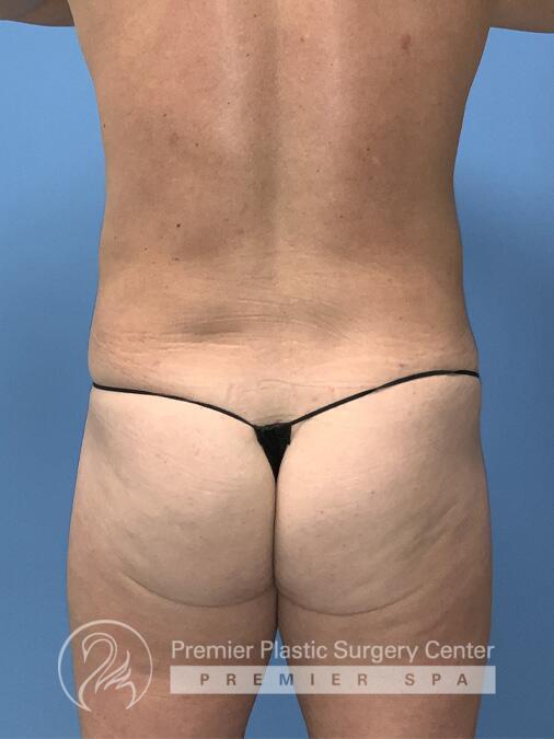 Liposuction Before & After Image