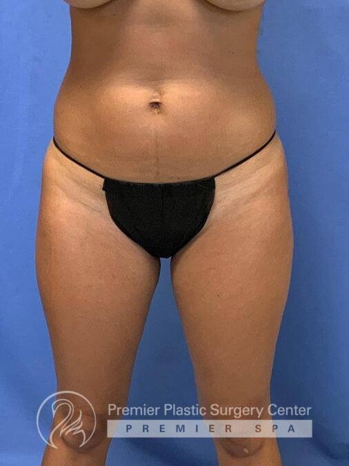 Liposuction Before & After Image