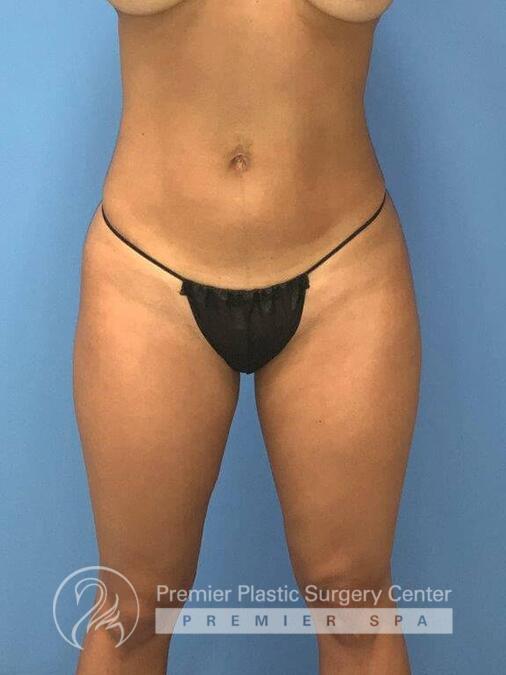 Liposuction Before & After Image