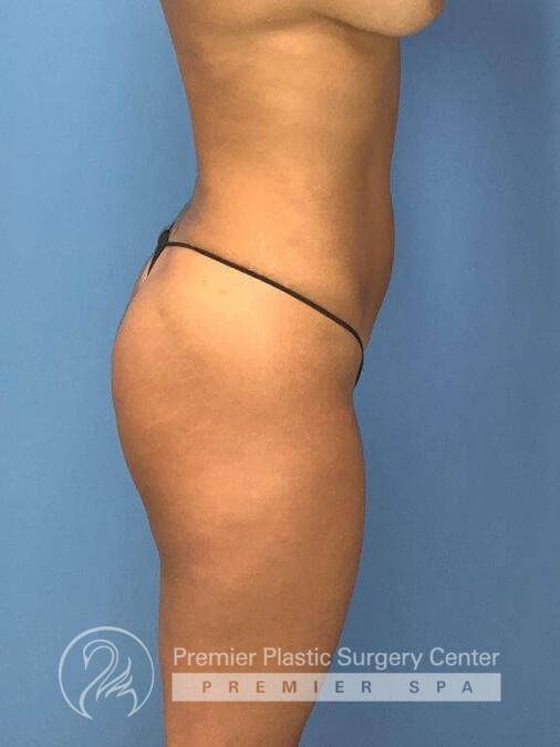 Liposuction Before & After Image