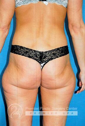 Liposuction Before & After Image