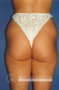 Liposuction Before & After Image