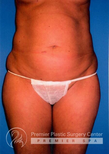 Liposuction Before & After Image