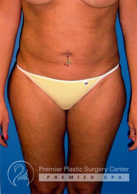 Liposuction Before & After Image