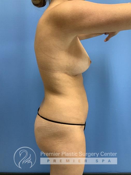 Liposuction Before & After Image