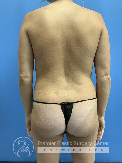 Liposuction Before & After Image