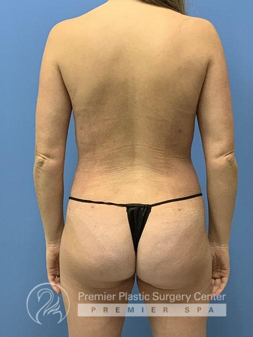 Liposuction Before & After Image