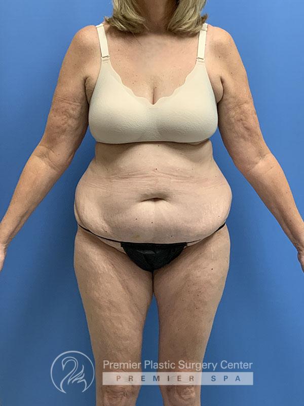 Liposuction Before & After Image