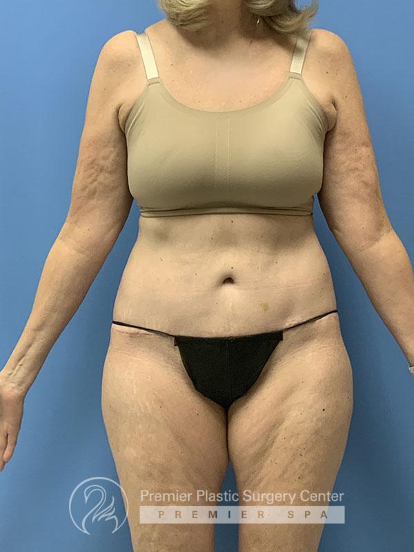 Liposuction Before & After Image