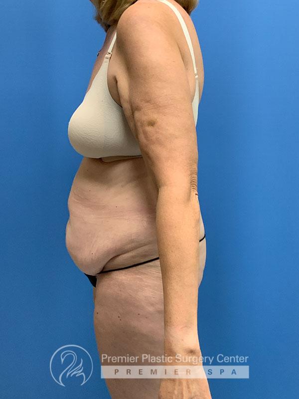 Liposuction Before & After Image