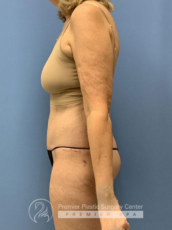 Liposuction Before & After Image