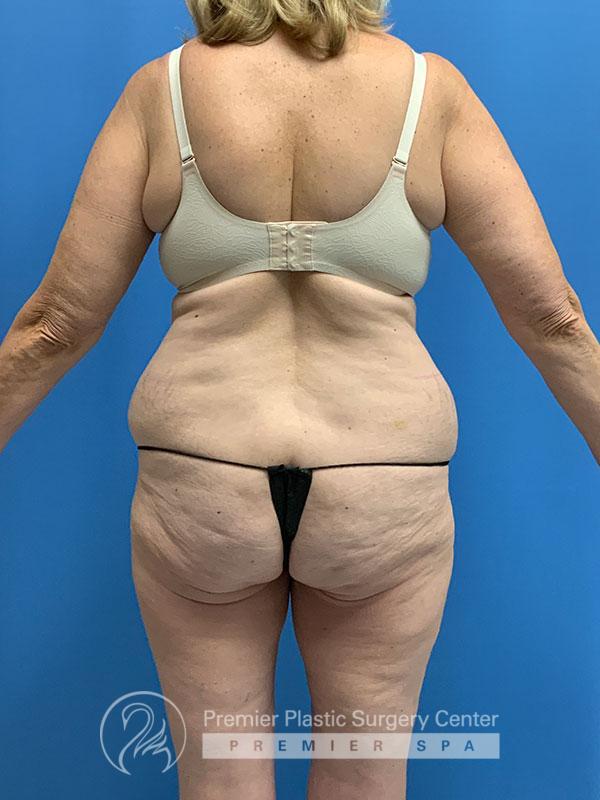 Liposuction Before & After Image