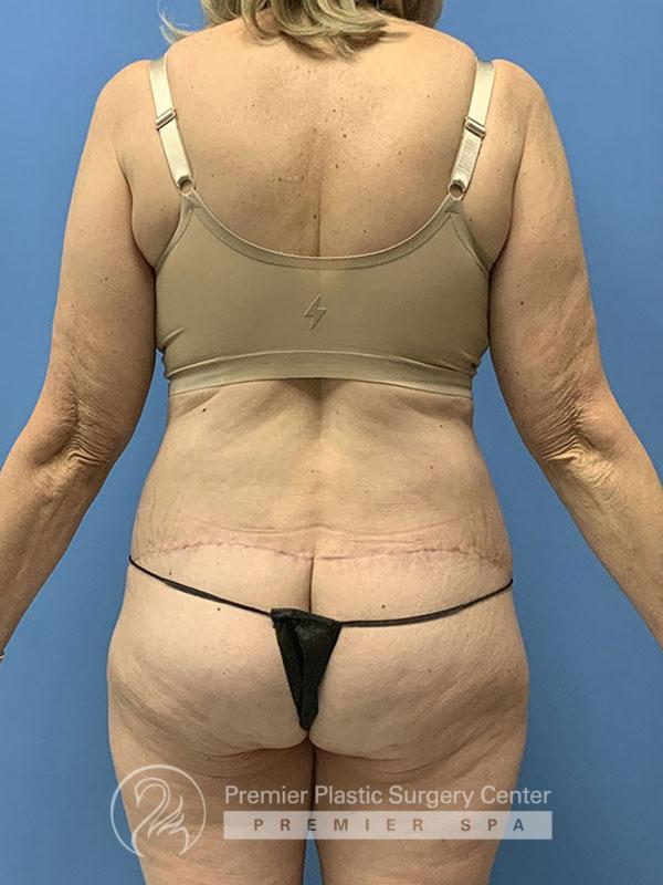 Liposuction Before & After Image