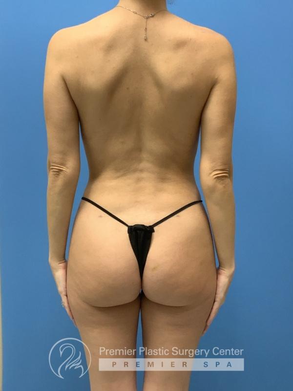 Liposuction Before & After Image