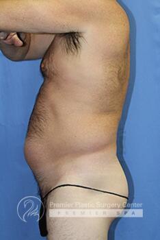 Liposuction For Men Before & After Image