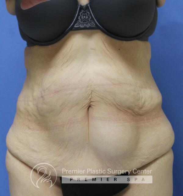 Skin Removal After Weight Loss Before & After Image