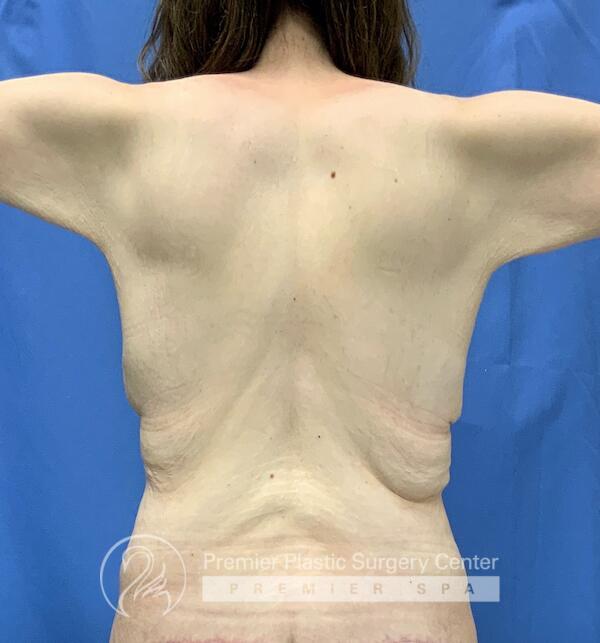 Skin Removal After Weight Loss Before & After Image