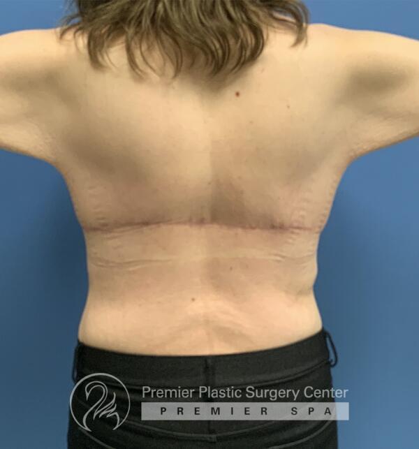 Skin Removal After Weight Loss Before & After Image