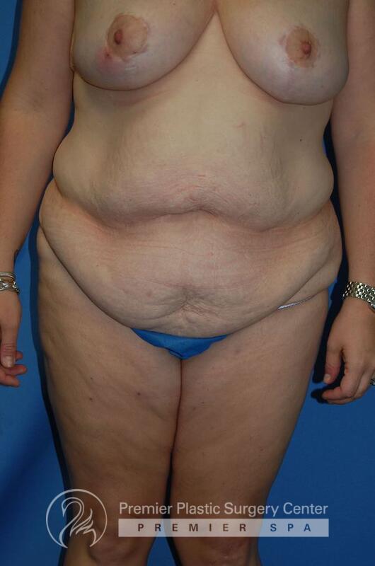 Skin Removal After Weight Loss Before & After Image