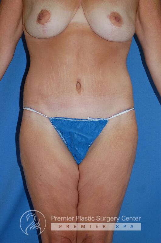 Skin Removal After Weight Loss Before & After Image