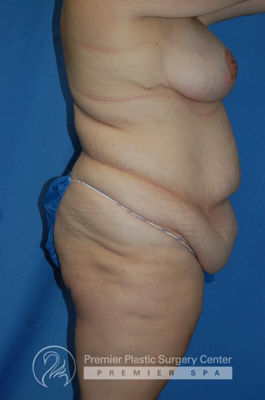 Skin Removal After Weight Loss Before & After Image