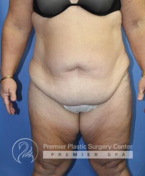 Skin Removal After Weight Loss Before & After Image