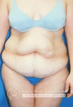 Skin Removal After Weight Loss Before & After Image