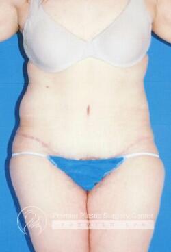 Skin Removal After Weight Loss Before & After Image