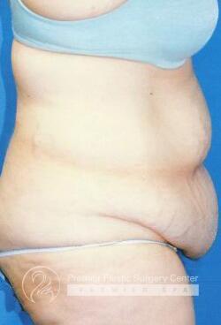 Skin Removal After Weight Loss Before & After Image