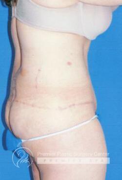 Skin Removal After Weight Loss Before & After Image