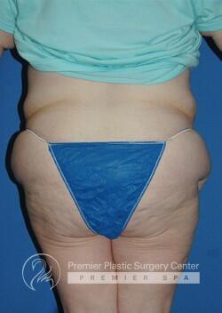 Skin Removal After Weight Loss Before & After Image
