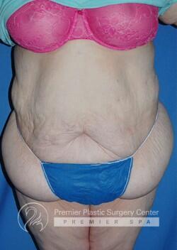 Skin Removal After Weight Loss Before & After Image