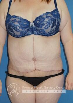 Skin Removal After Weight Loss Before & After Image